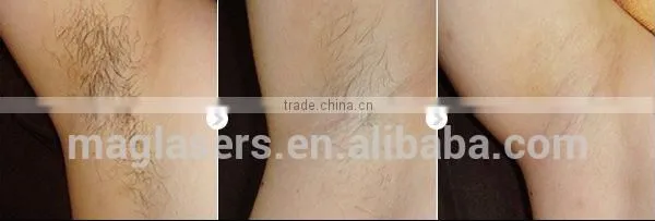 High Efficiency Shr Ipl Hair Removal/laser Hair Removal Machine Price photo-6