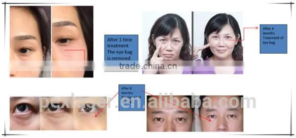 New Products 2016 Dark Eye Circle Removal Eye Beauty Machine photo-6