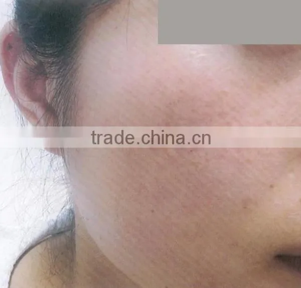 Cooling Comfortable Ipl Elight Machine Hair Removal and Skin Rejuvenation System photo-6