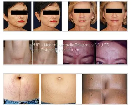 Personal Care PDT LED Skin Rejuvenation Device photo-4
