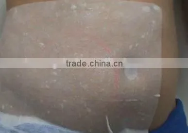 Antifreeze Membrane for Cryotherapy Slimming photo-5