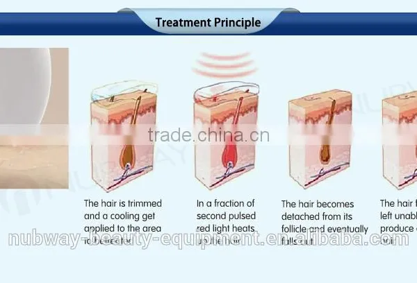 2017 New Design Laser Diodo Hair Removal/ Electric Hair Removal Machine Epilator/Nubway Laser Hair Removal Equipment for Sale photo-5