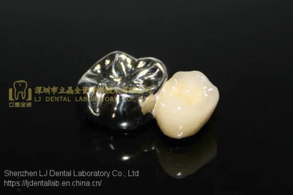 Full Metal Crown, FMC, FGC, Full Metal Post Core, Dental Crown, Cast Metal Crown, Dental Prosthesis, Laboratorio Dental, Dental Laboratory, Dentallabor, LJ Dental Lab China photo-2