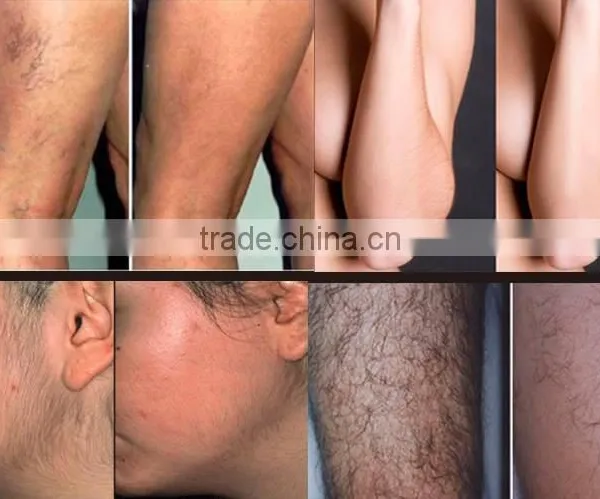 Safe And Effective Portable 808 Diode Laser Treatment For Unwanted Hair Removal From Face By Laser photo-6