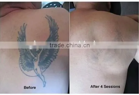 CE Approved Picosure Fractional Q-switched Laser for Big Tattoo Removal photo-5