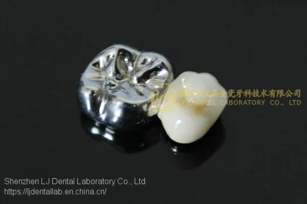 Full Metal Crown, FMC, FGC, Full Metal Post Core, Dental Crown, Cast Metal Crown, Dental Prosthesis, Laboratorio Dental, Dental Laboratory, Dentallabor, LJ Dental Lab China photo-3
