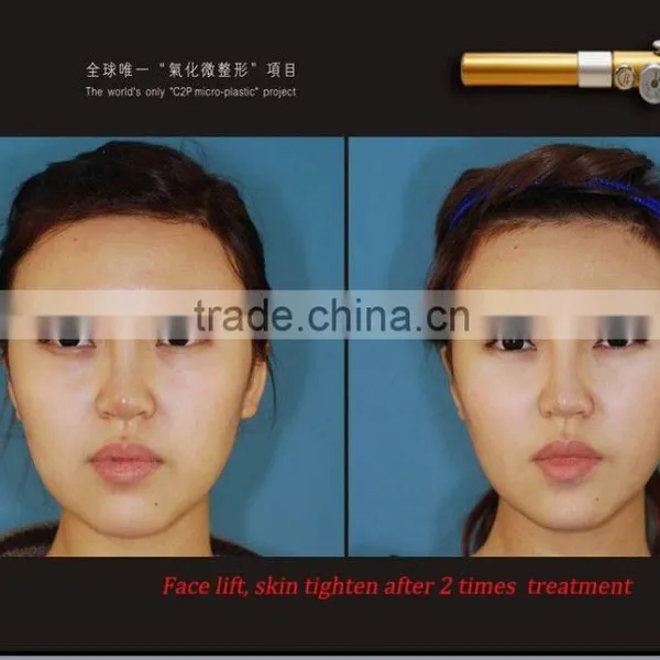 Hot in India Carboxy Treatment , Carboxy Treatment Equipment photo-4