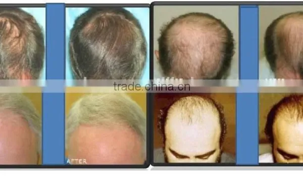650nm Diode Laser PDT Led Laser Hair Growth For Hair Loss Treatment photo-5