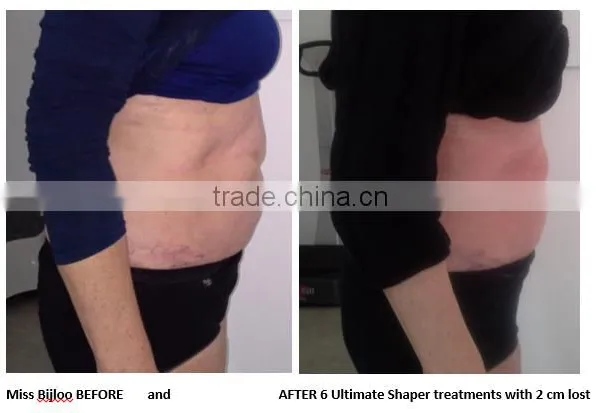 Back Tightening 2016 New Inventions Hifu Ultrasonic 4MHZ Liposuction Cavitation / Hifu Slimming Machine photo-6