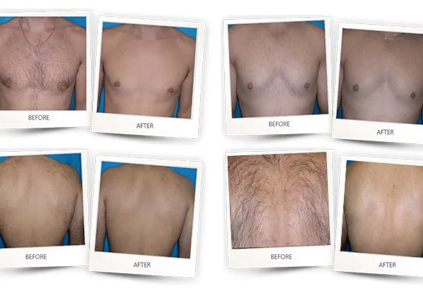 808nm Diode Laser Hair Removal Machine With 755nm 808nm 1064nm Triple Wavelength, 1200W Power, Sapphire Cooling Touch Screen photo-3