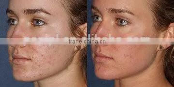 Spot Scar Pigment Removal Fractional Co2 Fractional Laser Vaginal Tightening Medical Treat Telangiectasis & Acne Scar Removal Machine CO2 Laser Skin Renewing photo-4