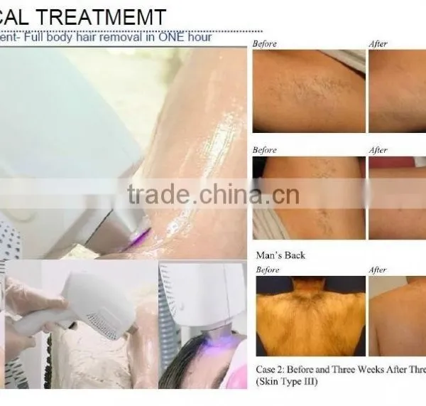 HOT!!!Vertical 808nm Diode Laser Hair Removal Beauty Equipment&machine photo-3