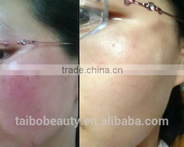 Distributor Low Price ! 980nm Spider Vein Removal Machine Vascular Remover 980 Varicose Vein Laser photo-3