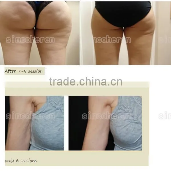 Body Shaping Slimming Machine Combine Vacuum Suction RF + Infrared Light + Roller Effective Body Slimming photo-6