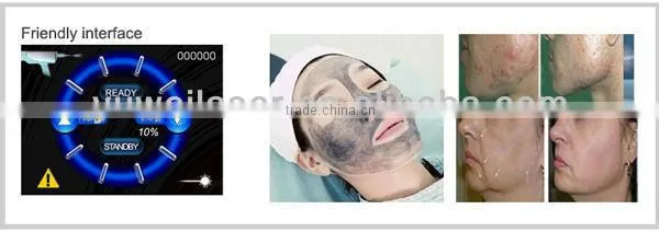 Q-switched Ndyag Laser,professional for Tattoo,pigment ,eyebrow Removal photo-5