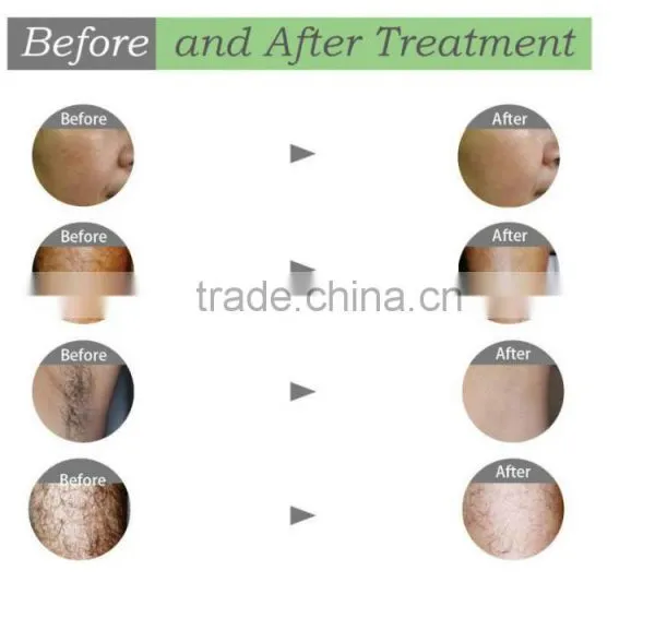 3 in 1 Multifunctional Salon Equipments Ipl Shr rf Skin Rejuvenation Elight Ipl rf nd Yag Laser/shr Hair Removal Laser-CE photo-6