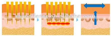 2015 New Product Medical CE Approval Microneedle Fractional RF for Skin Rejuvenation photo-4