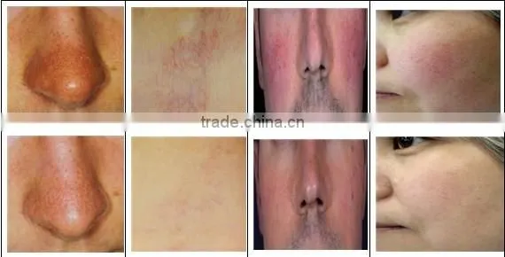 Professional Facial Vein Redness Removal Leg Spider Vein Removal Machine/ Most Advanced High Power Vascular Removal photo-6