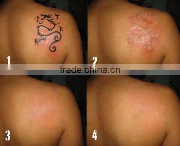 Home Use Portable q Switch Tattoo Removal 1064/532nm 1320nm nd Yag Laser photo-6