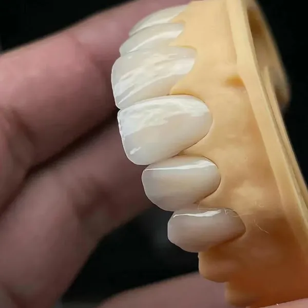 The Telescopic Crown Precision Attachment Denture Has Strong Stability photo-4