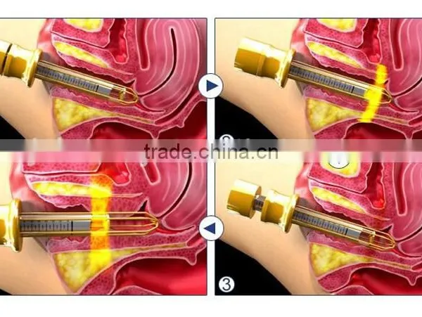 2016 Good Effect 25mm Focal Length Hifu Vaginal Tightening Machine With CE Certificate photo-6