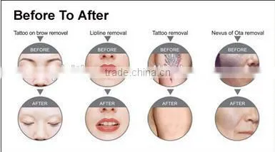 Discount Screen Logo Customized Nd Yag Laser Hair Removal Nd Yag Laser Ipl photo-3
