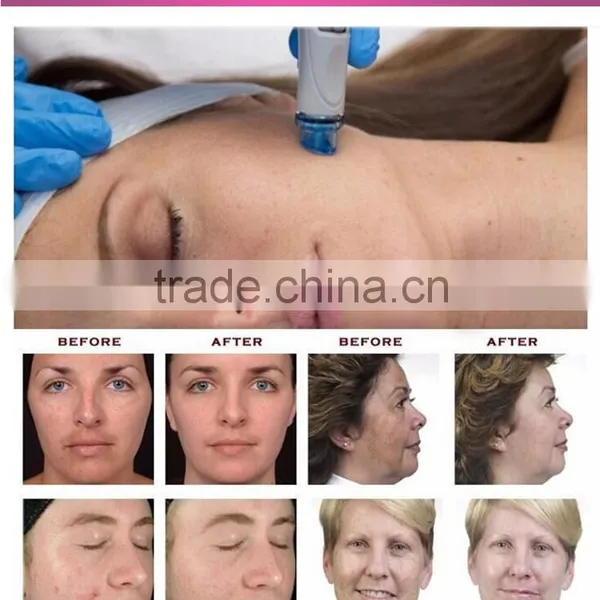 Oxygen Facial Skin Care Oxygen Water Spray Oxygen Facial Machine Jet Peel Face Spa Machine Skin Analysis photo-4