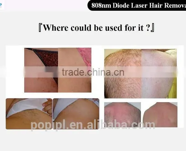Medical Laser Hair Remover photo-4