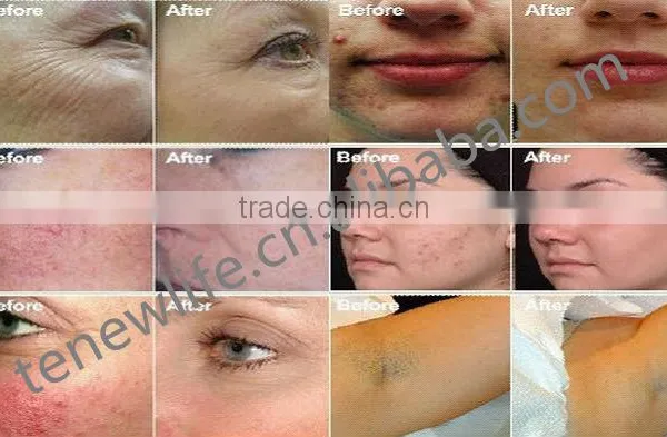 CE Certificated Galvanic BIO Wrinkle Removal Beauty Machine Anti Wrinkle Device for Whitening & Skin Care Facial & Lifting photo-3