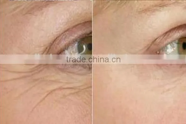RF Fractional Micro Needle / Fractional rf Wrinkle Removal Machine / Fractional rf photo-6