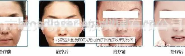 Anti-aging LED PDT Machine Lighting Skin care Pdt Beauty Instrument Laser Led Led Facial Light Therapy Machine photo-5