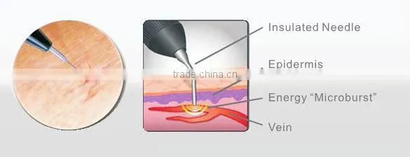 China Hair Salon Equipment Vascular Spider Vein Removal Machine photo-3