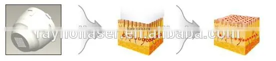Microneedle Fractional RF Radio Frequency ROYAL- FR200 Equipment photo-6