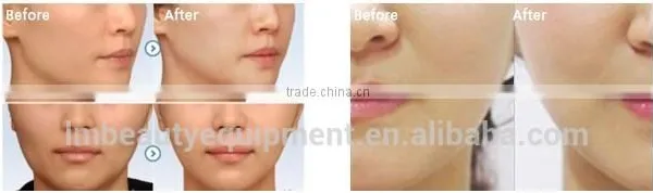 Fractional rf Wrinkle Removal Machine Skin White Whitening Cream photo-6