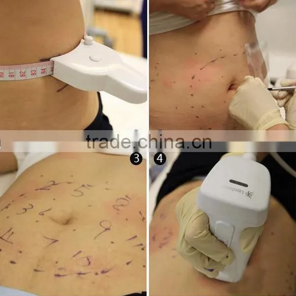 Weight Loss Hifu Ultrasound Expression Lines Removal Korea Slimming Machine FU-18S 0.1-2J photo-4
