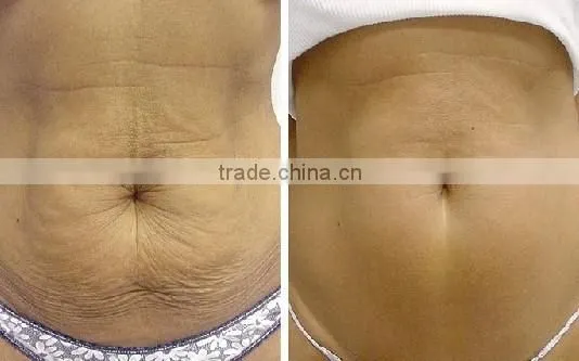 Cool Sculpting 2016 Wonderful Cryolipolysis Body Reduce Cellulite Slimming Machine/fat Freezing Beauty Machine photo-3