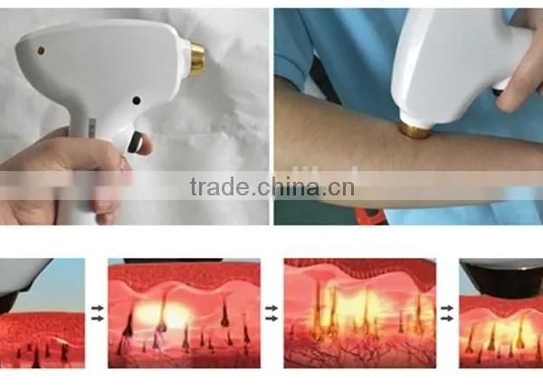 Germany Import Lamp 808nm Diode Laser Hair Removal/ Permanent Hair Removal Machine photo-3