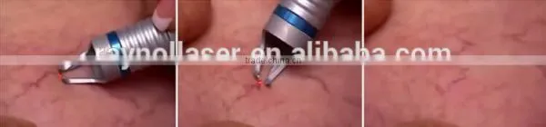 New Portable Vascular Removal Diode Laser Machine Price photo-6