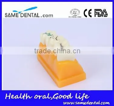 Pit and Fissure Model Dental Eduction Assitant No. DEA-19 photo-2