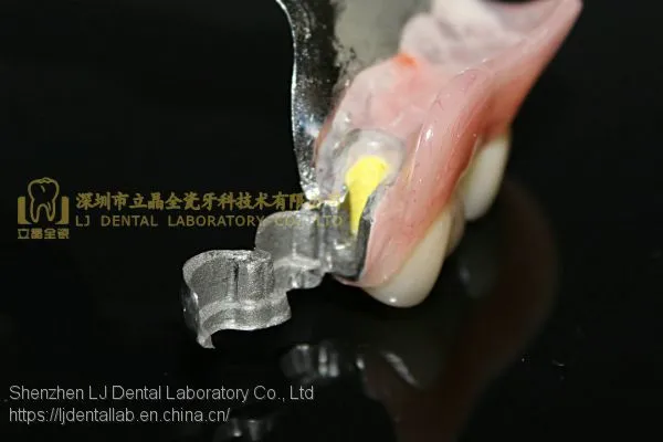 Dental Precision Attachment, Dental Attachment, Dental Denture, Laboratoire Dentaire, Dentallabor, Laboratorio Dental, Dental Laboratory, Shenzhen LJ Dental Lab China