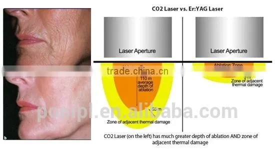 RF Co2 Fractional Laser Fractional Laser Treatment photo-3