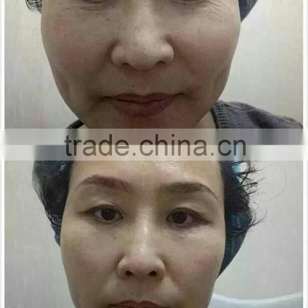 RED Light PDT LED Therapy for Skin Lightening Acne Removal photo-6