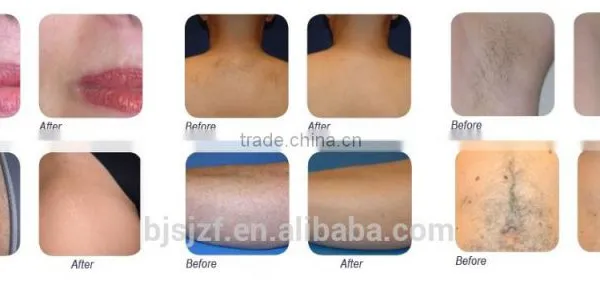808T-2 Mini 808nm Diode Laser Diode Beauty Device for Hair Removal photo-4
