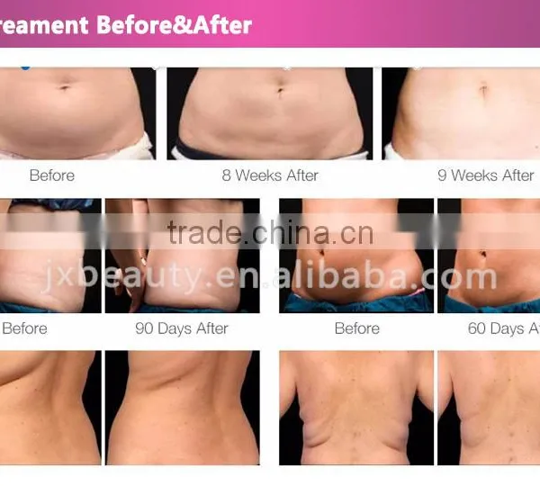 Liposuction Ultrasonic Machine That Remove Belly Fat photo-6