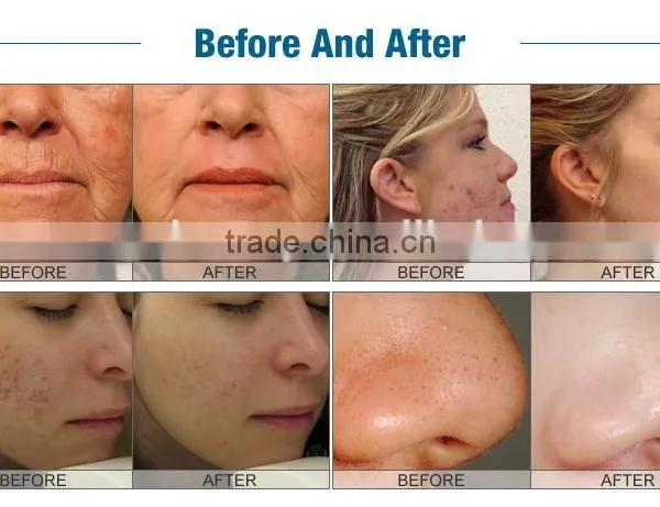 4in1 Facial Beauty Equipment for Hydro Skin Rejuvenation photo-6