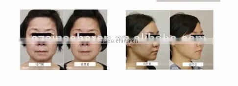 Protable Hifu Korea Face Lift/ Slimming Machine/ High Intensity Focused Untrasound photo-4