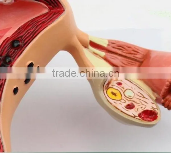 Human Uterus and Ovary Vaginal Pathological Changes Model of Reproductive Department of Gynecology Medical Demonstration Model photo-4