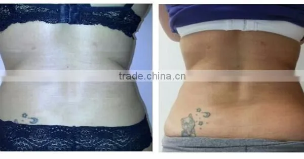 Spa Use Machine for Body Scupture Fat Removal Slimming Cryolipolise photo-5