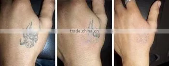 Naevus Of Ito Removal Highest Energy 2000mj Of Q Tattoo Removal Laser Machine Switched Nd Yag Laser Picosecond Tattoo Removal Machine With 1064/1320/532nm photo-5