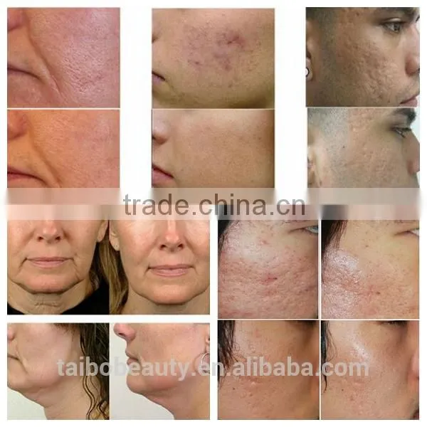 Facial Muscle Stimulator Fractional RF Skin Tightening rf Microneedle Electric Wrinkle Remover Machine photo-6